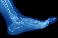 What Can Cause a Stress Fracture?