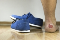 Eczema on the Feet
