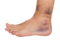 Recognizing Symptoms of Ankle Sprains